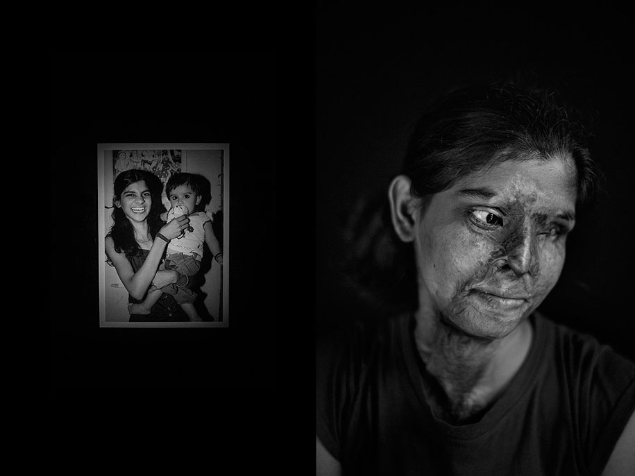“Acid Survivors in India” by Jordi Pizarro — Conceptual, Professional